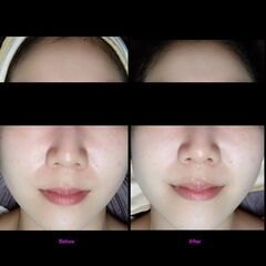 New❢　フェイシャルメニュー　紫外線疲れのお肌へ。。洗浄＆美容成分浸透トリートメント − 埼玉県
