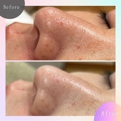 一度で変化がわかる❣️老化角質を除去し赤ちゃん肌へ・・・✨ - 美容