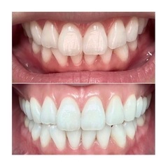 【歯の黄ばみ】１回で白く！歯のホワイトニング@池袋 - 美容