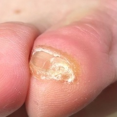 ストッキングをダメにしたのは…副爪❗️の画像