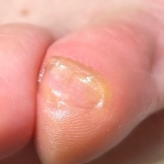 ストッキングをダメにしたのは…副爪❗️ - 横浜市