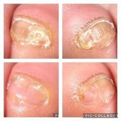 ストッキングをダメにしたのは…副爪❗️ - 地元のお店