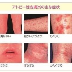 ✨シミ、シワ、アトピーや乾癬など深刻な肌のお悩みの方 募集✨ - 仙台市