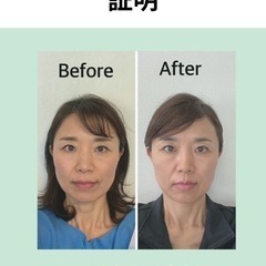 小顔矯正のビフォーアフター写真撮影OKの方モニター募集