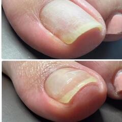 巻き爪・爪切り
