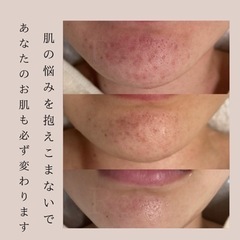 下関毛穴ケア専門レピアの画像