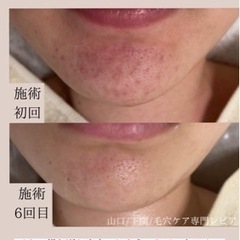 下関毛穴ケア専門レピア