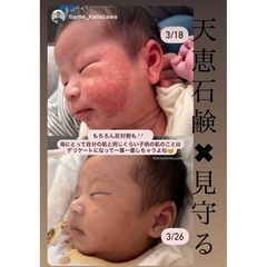 アトピー　アレルギー　乳児湿疹