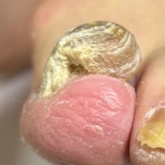 痛みの限界❗️厚い爪＝肥厚爪