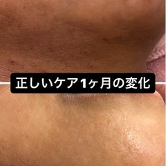 アトピー　もたるみも諦めないで