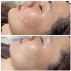 【毛穴】【くすみ】肌悩みの方是非お願いします！！