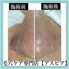 【再募集】毛穴ケア専門店⭐︎モニター募集1名！！ - 美容