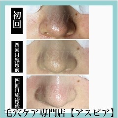 【再募集】毛穴ケア専門店⭐︎モニター募集1名！！ − 福岡県