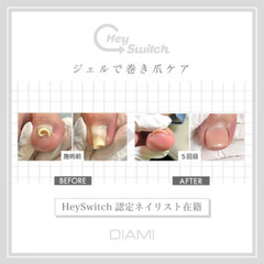 【日本初上陸！痛くない!】巻き爪ケアいたします