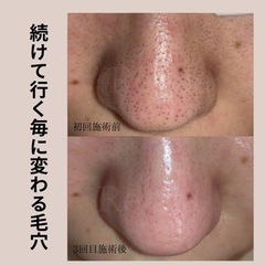 毛穴スッキリコース