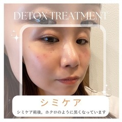 おすすめ！低周波シミとり✨お肌に優しくシミを取ります