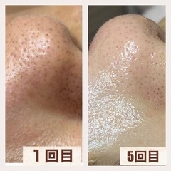 毛穴の黒ずみ、ざらざら一気に解消☆