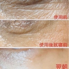 【しわ.たるみ肌改善】プレミアムインジェクション針を使わない注入美容💆‍♀️ヒト幹細胞・天然微細針スピキュール - 熊本市