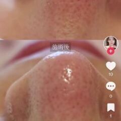 韓国式3D毛穴洗浄施術¥0【エステサロンオーナー様のみ】