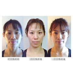 ★大きなお顔・むくみ・ゆがみを改善したいなら★痛くない小顔矯正＆頭蓋骨矯正★いとぐち式小顔整体★ご新規様限定★ - 地元のお店