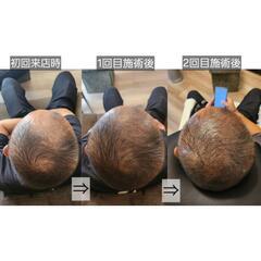 最新技術🌟SCALP INK(スカルプインク) - 那覇市