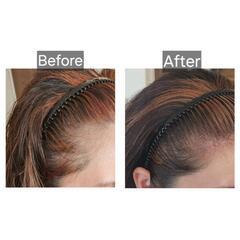 最新技術🌟SCALP INK(スカルプインク) - 美容
