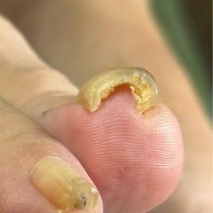 御礼メール来ました‼️巻爪矯正❗️