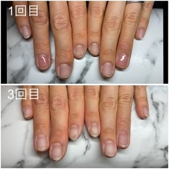 深爪矯正　爪育成　深爪で悩まれている方