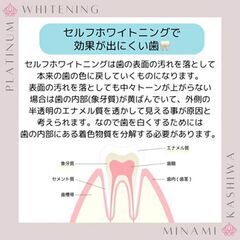 セルフホワイトニングで効果が出にくい歯とは？★回数券が45%OF...