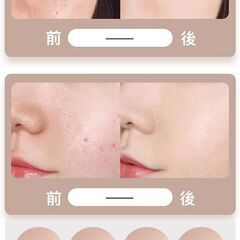 ★シミ ほくろ 除去 美肌 レーザーペン 充電式 BEAUTY MOLE REMOVAL SWEEP SPOT PENの画像