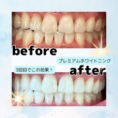 初回限定✨セルフホワイトニング体験1680円 - 向日市