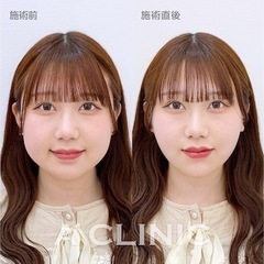 顔脂肪吸引系リフト一緒に行く友達募集
