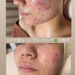 ハーブピーリング｜広告の無料掲載(2ページ目)｜ジモティー