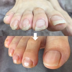 (手足の爪整え)引っ掛かりのない、なめらかな爪先に仕上げます