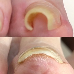 出張しますよ❗️巻爪矯正❗️