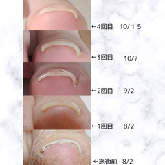 巻き爪ケアできます👣