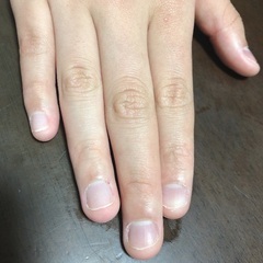 自爪育成モデルさん募集(施術料金500円〜