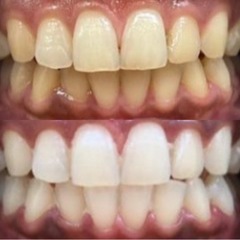 Ystyleのホワイトニング