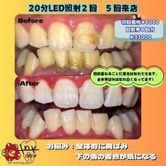 💎短時間で白い歯に🦷💎