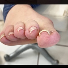 巻き爪痛くて悩んでる方