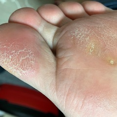足裏に魚の目・イボ・たこがあり、歩くだけで疲れる人へ