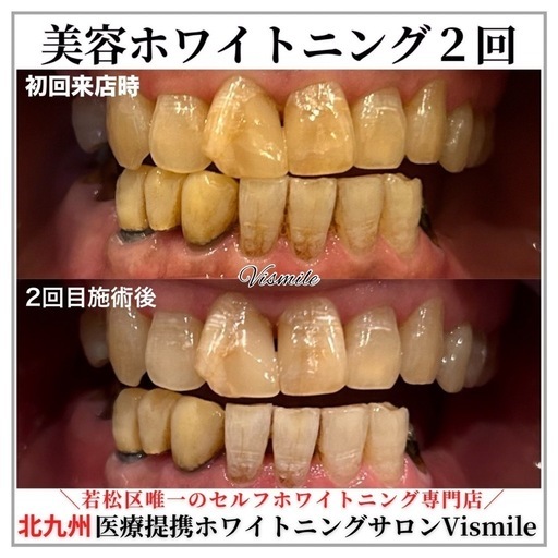 美容ホワイトニング×２セット