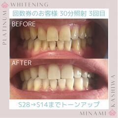 ホワイトニング回数券で通っていただいてるお客様の ビフォーアフタ...