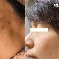 ＜2台限定 新品＞次世代脱毛器 1200万→300万【3本タイプ：SHR＋IPL&Elight＋YAGレーザー】トリプル脱毛＋RFフォト エステ業務用脱毛機の画像