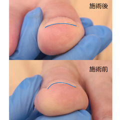 巻き爪ケア