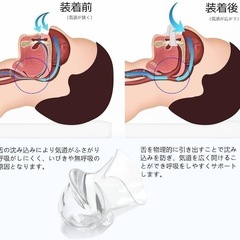 Joyeear いびき防止マウスピースの画像