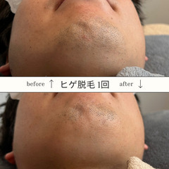 １度で効果実感！メンズ脱毛サロン【錦市場すぐ】 - 美容