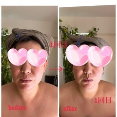 切らない糸リフトキャンペーンで嬉しいご感想