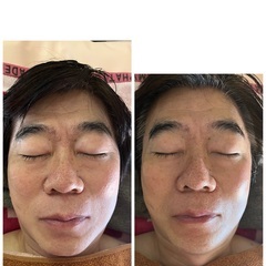 切らない糸リフトキャンペーンで嬉しいご感想の画像