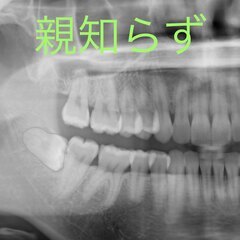 親知らずを抜いたほうがいい理由